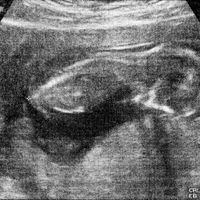 Ayuda con método ramzi: niño o niña? - 2