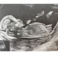 Ayuda con método ramzi: niño o niña? - 1