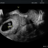 Futuras mamis Junio 2022!! - 1
