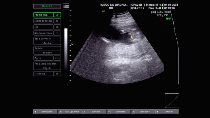 Tubérculo genital: niña - 2