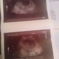Tubérculo genital: niña - 1