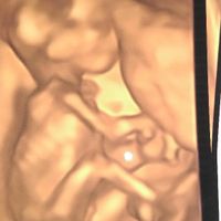 Buscadoras después de uno o varios abortos ii - 2