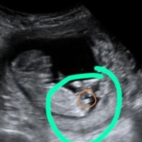 Ayuda con método ramzi: niño o niña? - 1