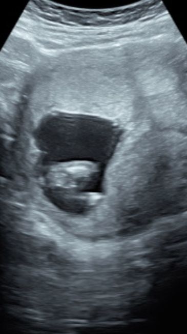 Tubérculo genital: niña - 2