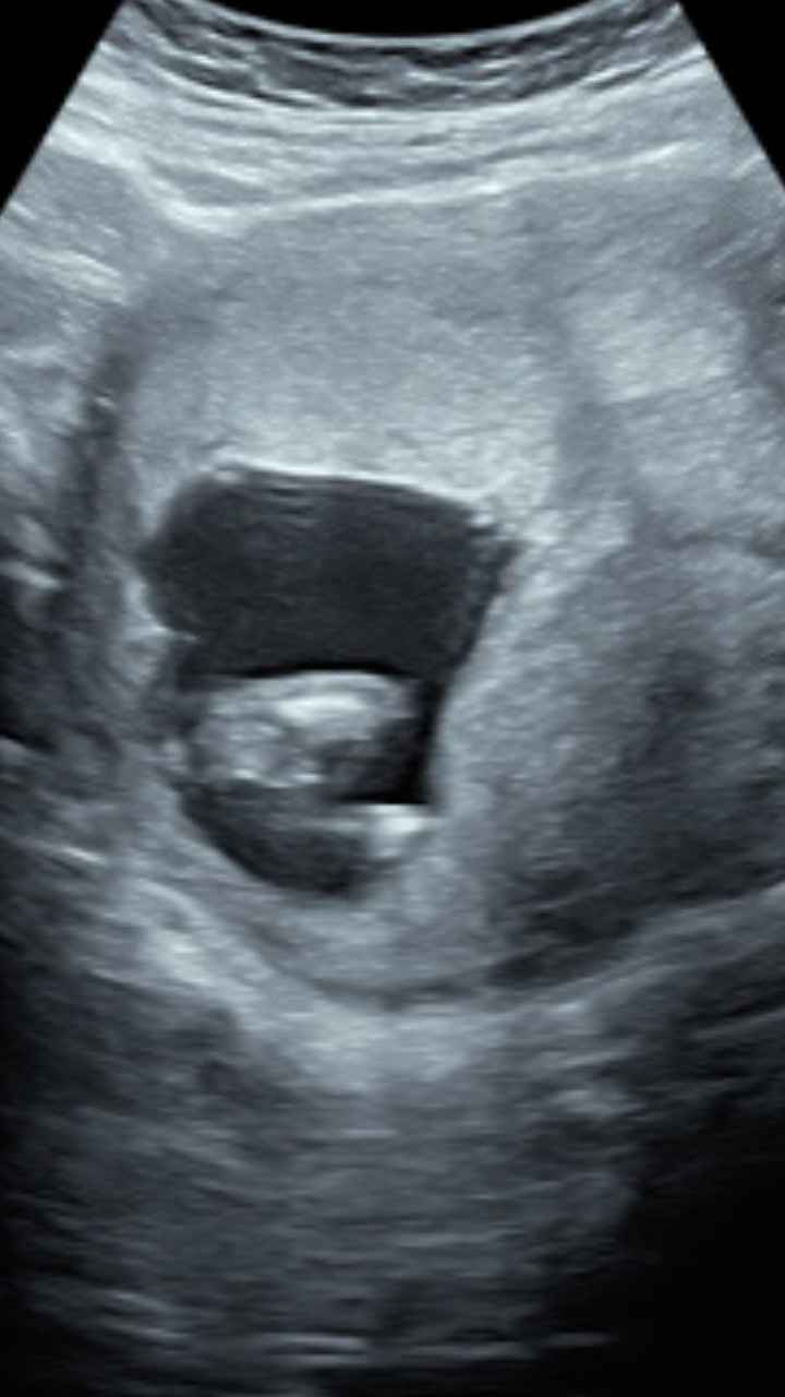 Tubérculo genital: niña 18