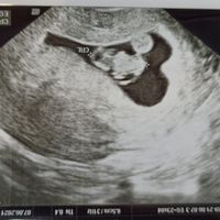 Ayuda con método ramzi: niño o niña? - 1