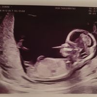 Ayuda con método ramzi: niño o niña? - 1