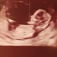 Ayuda con método ramzi: niño o niña? - 2