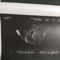 Ayuda con método ramzi: niño o niña? - 1