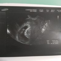 Ayuda con método ramzi: niño o niña? - 2