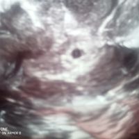 Ayuda con método ramzi: niño o niña? - 1