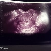 Ayuda con método ramzi: niño o niña? - 2