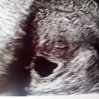 Ayuda con método ramzi: niño o niña? - 1