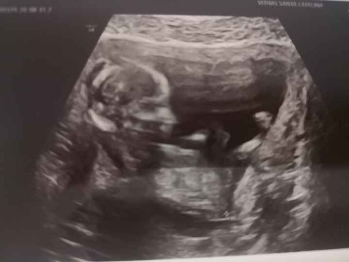 Tubérculo genital: niña - 2