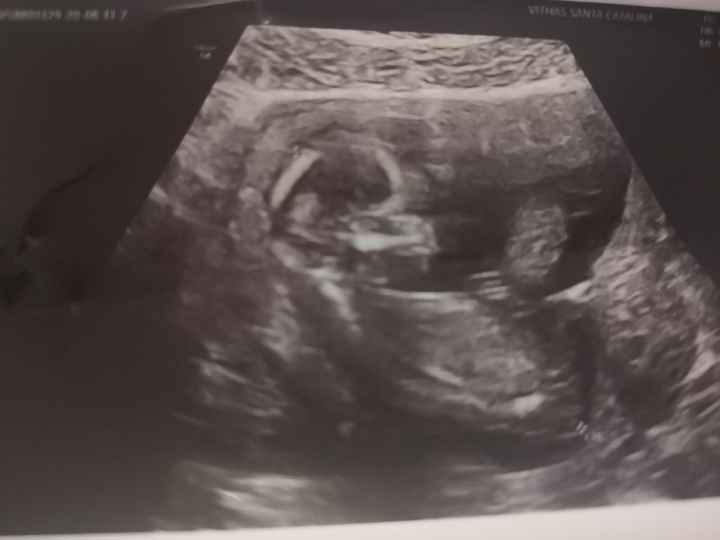 Tubérculo genital: niña - 3
