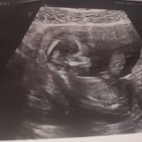 Tubérculo genital niño o niña??? - 1
