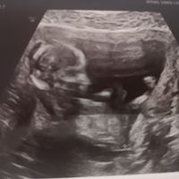 Tubérculo genital niño o niña??? - 2