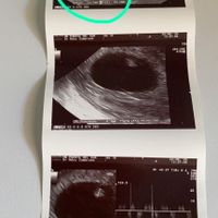 Ayuda con método ramzi: niño o niña? - 1