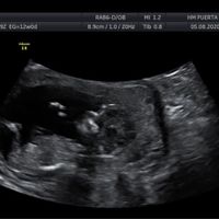 Tubérculo genital niño o niña??? - 1
