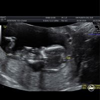 Tubérculo genital niño o niña??? - 2