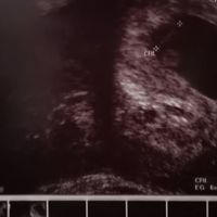 Ayuda con método ramzi: niño o niña? - 1
