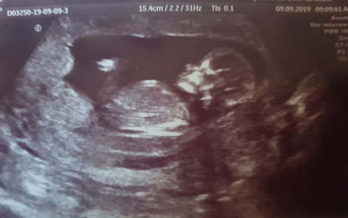 Tubérculo genital: niña - 1