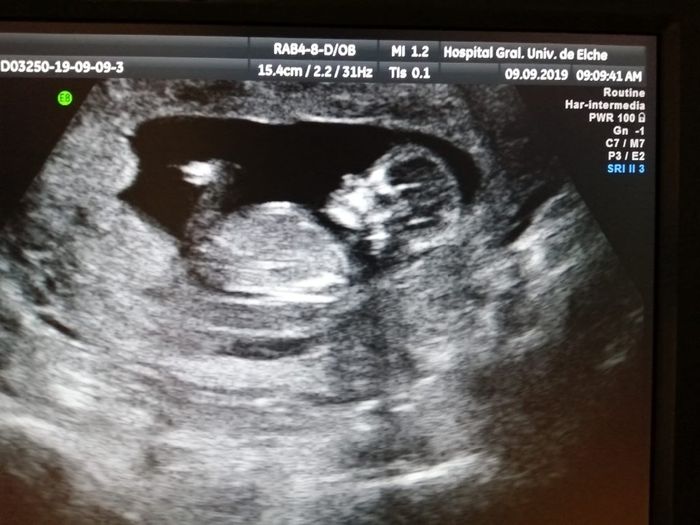 Tubérculo genital: niña - 3