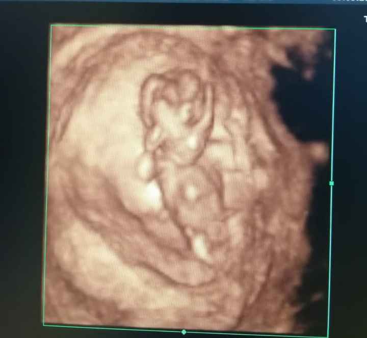 Tubérculo genital: niña - 4