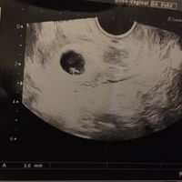 Ayuda con método ramzi: niño o niña? - 1