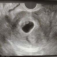 Ayuda con método ramzi: niño o niña? - 1