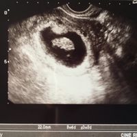 Ayuda con método ramzi: niño o niña? - 1