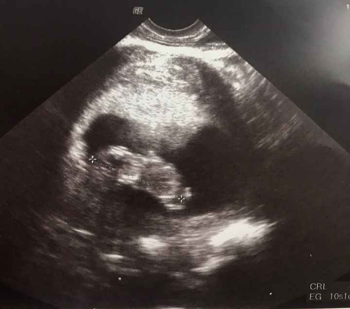 Ayuda con método ramzi: niño o niña? - 1