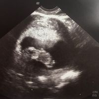 Ayuda con método ramzi: niño o niña? - 1