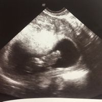 Ayuda con método ramzi: niño o niña? - 2