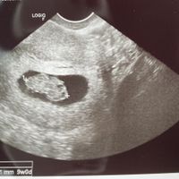 Ayuda con método ramzi: niño o niña? - 2