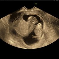 Ayuda con método ramzi: niño o niña? - 1