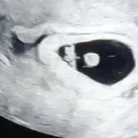 Ayuda con método ramzi: niño o niña? - 1