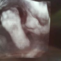 Buscadoras después de uno o varios abortos  - 2