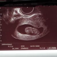 Ayuda con método ramzi: niño o niña? - 1