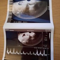 Ayuda con método ramzi: niño o niña? - 1