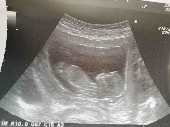 Tubérculo genital: niña - 1