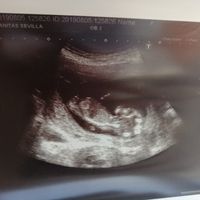 Tubérculo genital: niña - 2
