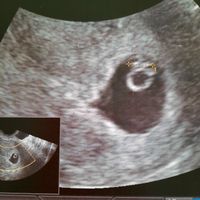Ayuda con método ramzi: niño o niña? - 1
