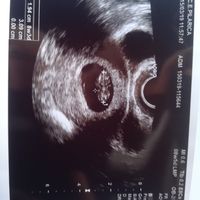 Ayuda con método ramzi: niño o niña? - 1