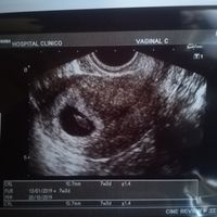 Ayuda con método ramzi: niño o niña? - 2