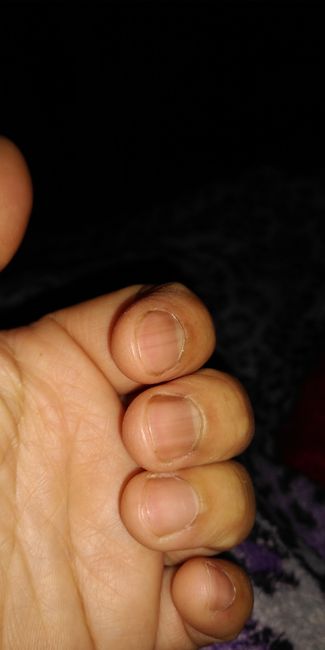 Rayas negras en las uñas de las manos - 1