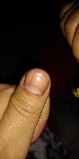 Rayas negras en las uñas de las manos - 2