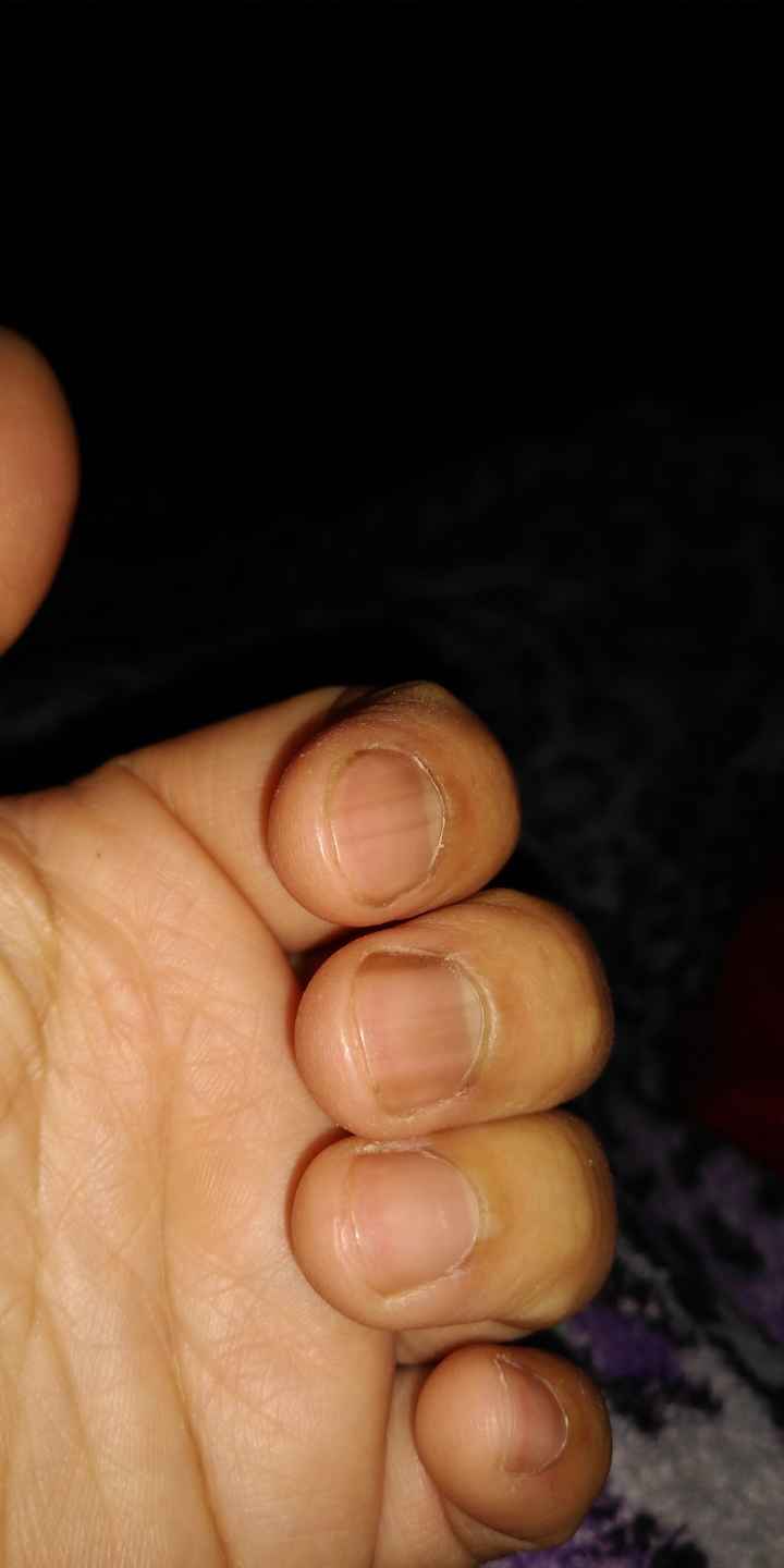 Rayas negras en las uñas de las manos 2