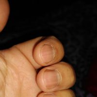 Rayas negras en las uñas de las manos - 1