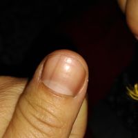 Rayas negras en las uñas de las manos - 2
